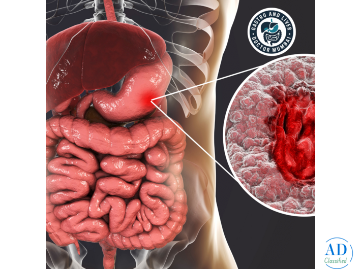 Dr. Harshad Joshi Offers the Best Peptic Ulcer Treatment in Mumbai