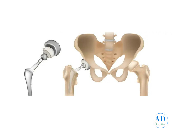 Hip Replacement Surgery in Ahmedabad | Trusted Orthopedic Care