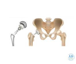 Hip Replacement Surgery in Ahmedabad | Trusted Orthopedic Care