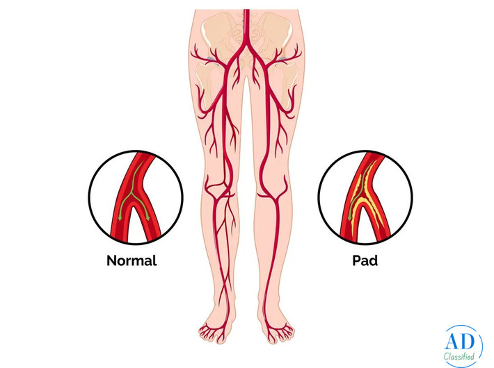 PAD Specialist: Expert Care for Peripheral Artery Disease