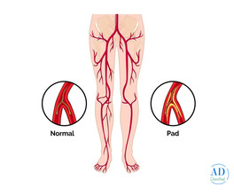 PAD Specialist: Expert Care for Peripheral Artery Disease