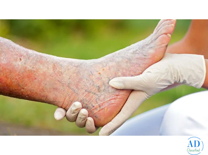 Stem Cell Treatment for Critical Limb Ischemia