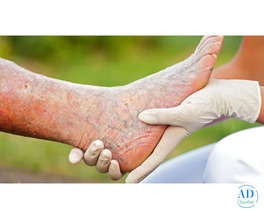 Stem Cell Treatment for Critical Limb Ischemia