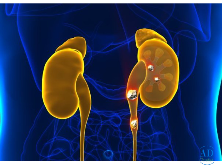 Kidney Stone Treatment in Mumbai | Dr Chandan Chaudhari – Expert Urologist