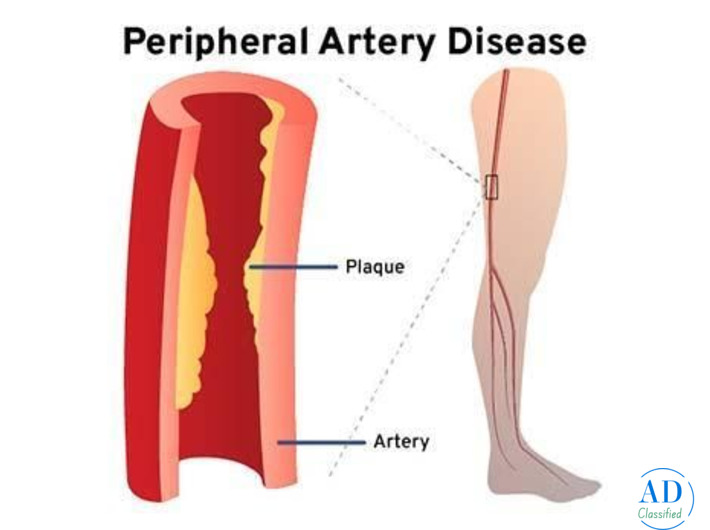 Peripheral Arterial Doppler: Advanced Test