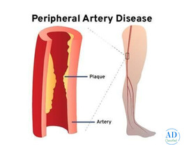 Peripheral Arterial Doppler: Advanced Test