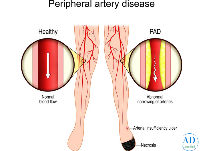 Management of Peripheral Arterial Disease: Effective Diagnosis and Treatment Options
