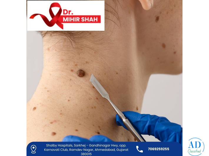 Highly Experienced Head and Neck Cancer Surgeon in Ahmedabad Dr Mihir Shah