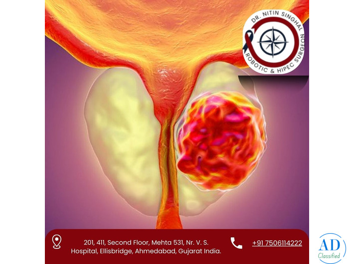 Best Prostate Cancer Surgeon in Ahmedabad – Dr. Nitin Singhal