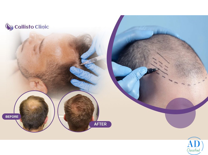 Best Hair Transplant Treatment in Surat - Callisto Clinic
