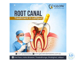 Best Root Canal Treatment in Lalitpur