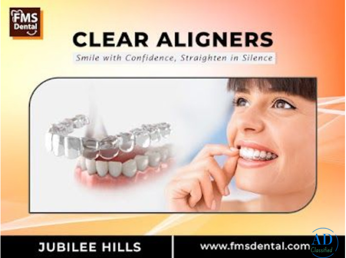 CLEAR ALIGNERS – The Modern Way to Straighten Teeth
