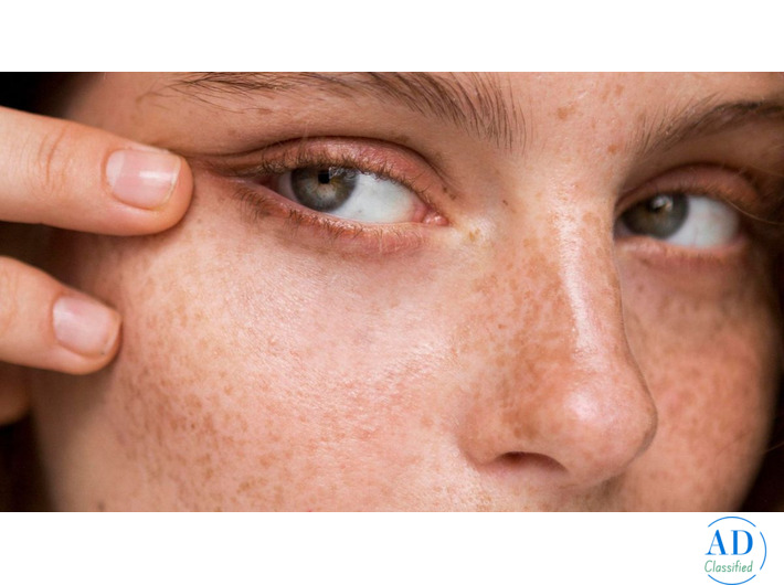 Effective Acne Scar Treatment Solutions in Dubai