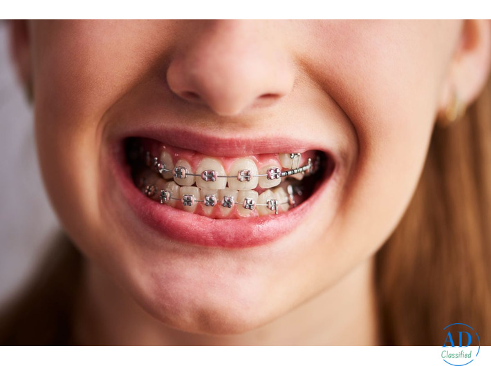 Braces Near You for Safe and Effective Teeth Straightening