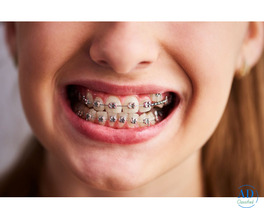 Braces Near You for Safe and Effective Teeth Straightening
