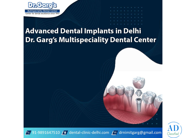 Advanced Dental Implants in Delhi | Dr. Garg’s Multispeciality Dental Center