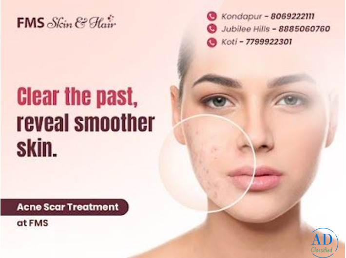 Best Acne treatment in Hyderabad