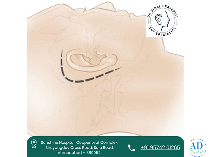 Best ENT Doctor for Facial Nerve Decompression in Ahmedabad – Dr. Viral Prajapati