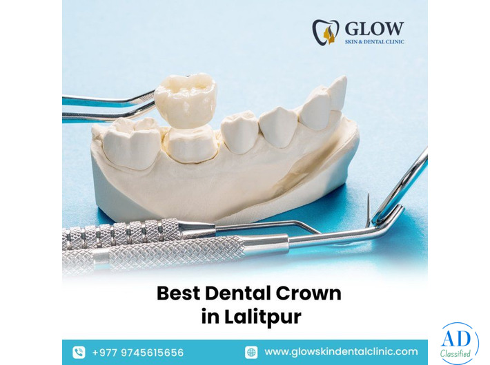 Best Dental Crown in Lalitpur