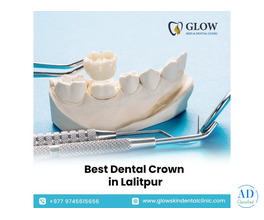 Best Dental Crown in Lalitpur