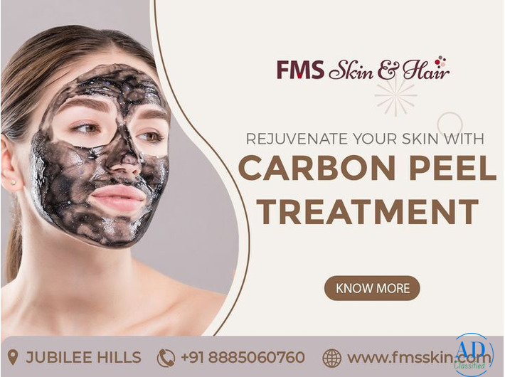 Carbon Peel Laser Treatment in Hyderabad