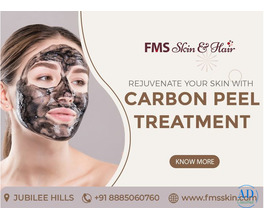 Carbon Peel Laser Treatment in Hyderabad