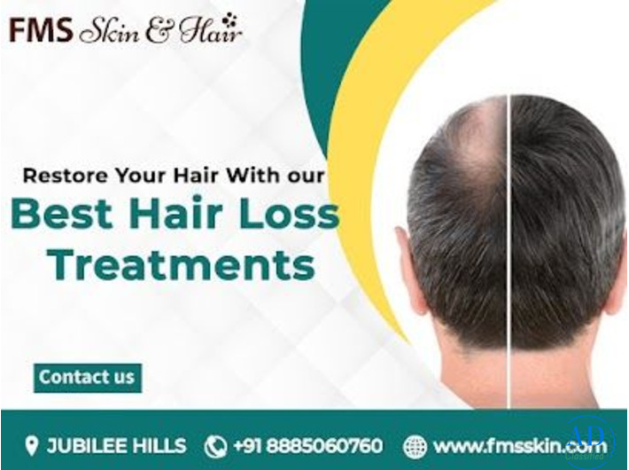 Hair Loss Treatment in Hyderabad - FMS skin & hair clinic