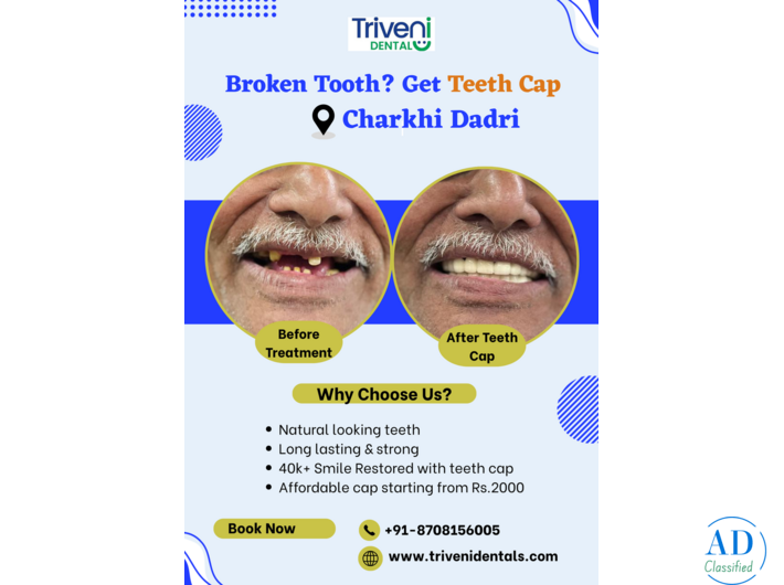 Teeth Cap Treatment in Charkhi Dadri | Triveni Dental