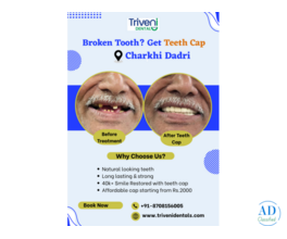 Teeth Cap Treatment in Charkhi Dadri | Triveni Dental