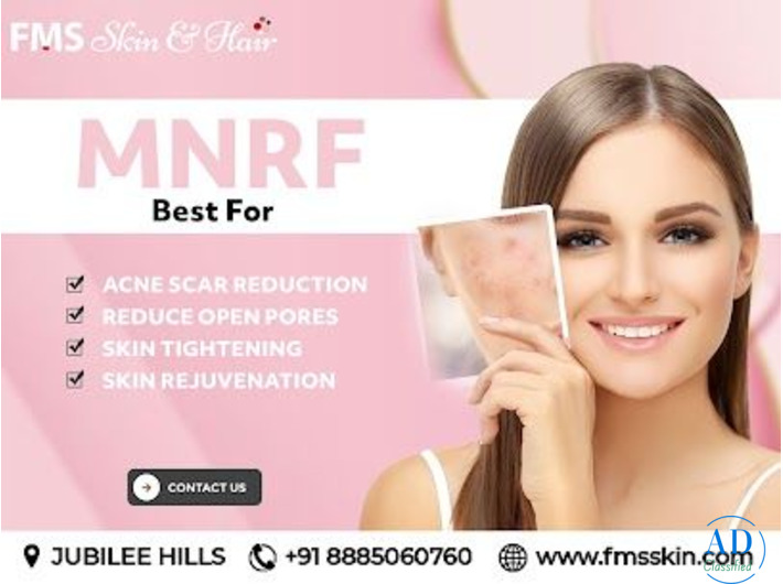 MNRF treatment in Hyderabad - FMS Skin & Hair