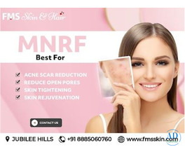 MNRF treatment in Hyderabad - FMS Skin & Hair