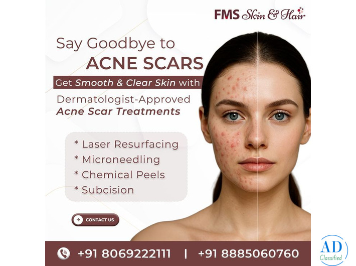 Best Acne Scar Treatment in Hyderabad - FMS Skin & Hair