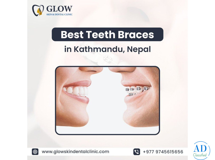 Best Teeth Braces in Kathmandu, Nepal