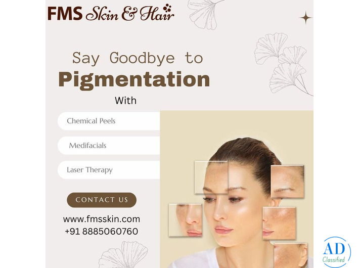 Best Pigmentation Treatment in Hyderabad