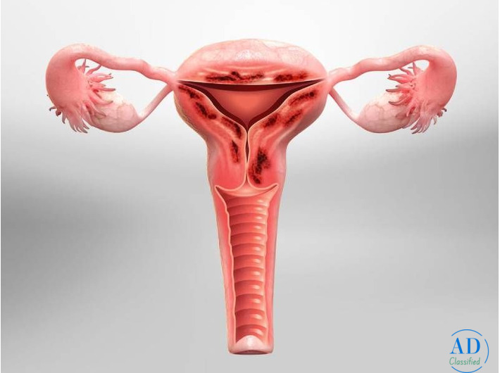 Effective & Personalized Adenomyosis Treatment in Wakad