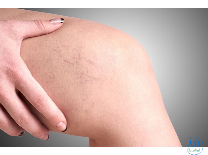 Experienced Varicose Veins Doctor for Advanced and Painless Treatment