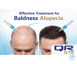 Advanced Baldness Alopecia Treatment with QR678 Therapy
