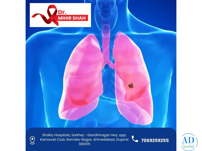 Best Lung Cancer Treatment in Ahmedabad – Dr. Mihir Shah
