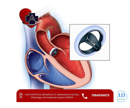 Best Heart Valve Surgery in Ahmedabad – Dr. Abhishek Parmar