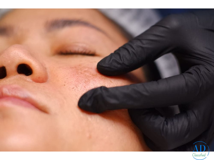 Professional Solutions for Melasma Treatment and Dark Spot Removal in Dubai