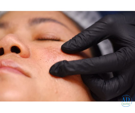 Professional Solutions for Melasma Treatment and Dark Spot Removal in Dubai