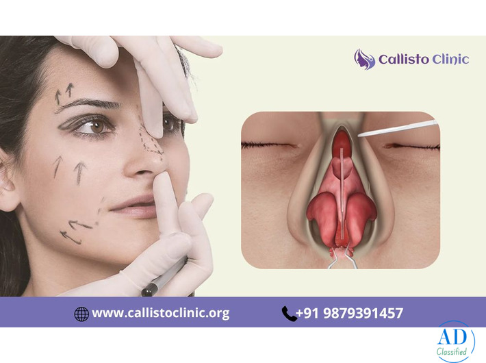 Cosmetic Rhinoplasty in Surat for a Balanced Facial Look - Callisto Clinic