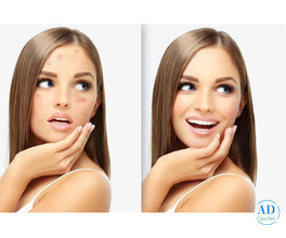 Acne vs Acne Scars: Finding the Right Treatment for Clearer Skin