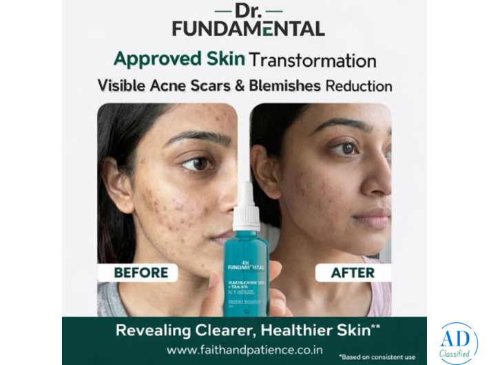 Niacinamide Serum for Acne: Benefits, Uses & Best Results Guide (2026)