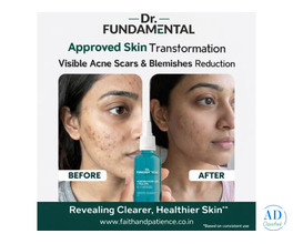 Niacinamide Serum for Acne: Benefits, Uses &amp; Best Results Guide (2026)