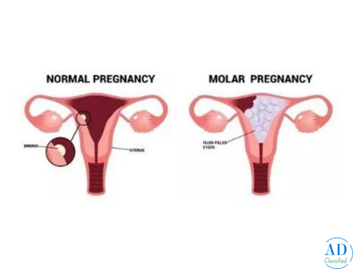 Advanced Molar Pregnancy Treatment in Kolkata | Uma Medical