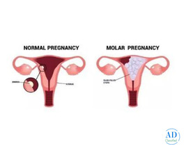 Advanced Molar Pregnancy Treatment in Kolkata | Uma Medical