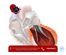 Dr. Abhishek Parmar – Left Ventricular Aneurysm Treatment in Ahmedabad