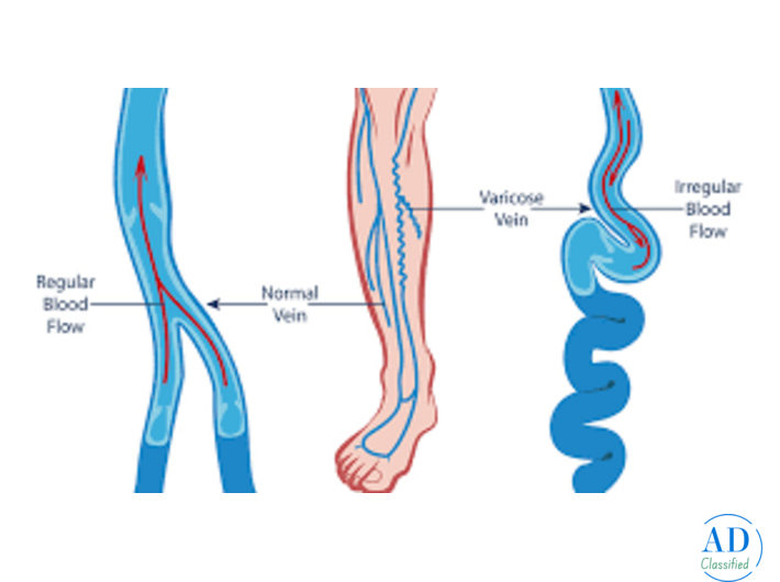 Best Hospital for Varicose Vein Treatment in India | Advanced & Affordable Care