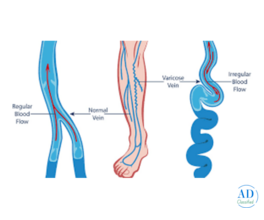 Best Hospital for Varicose Vein Treatment in India | Advanced &amp; Affordable Care